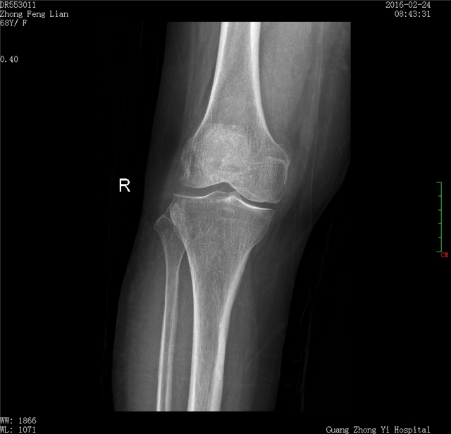 我院成功实施腓骨截骨术+关节镜手术治疗膝骨关节炎