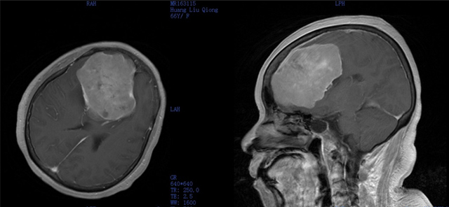 我院外六科成功救治1例颅底廉旁巨大脑肿瘤患者