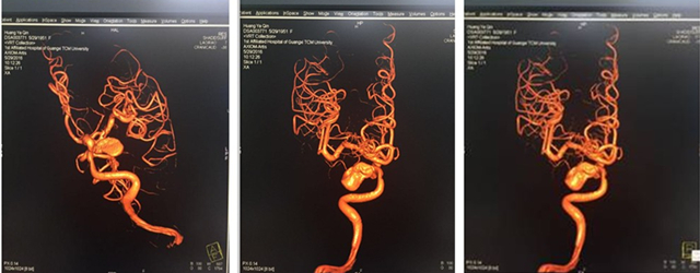 广西首例“双密网支架桥接封堵颅内动脉瘤”手术在我院成功施行