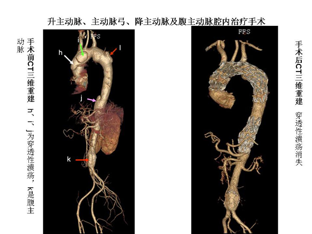 外七科完美的演绎了一例升主动脉、主动脉弓、降主动脉及腹主动脉的高难度的血管腔内治