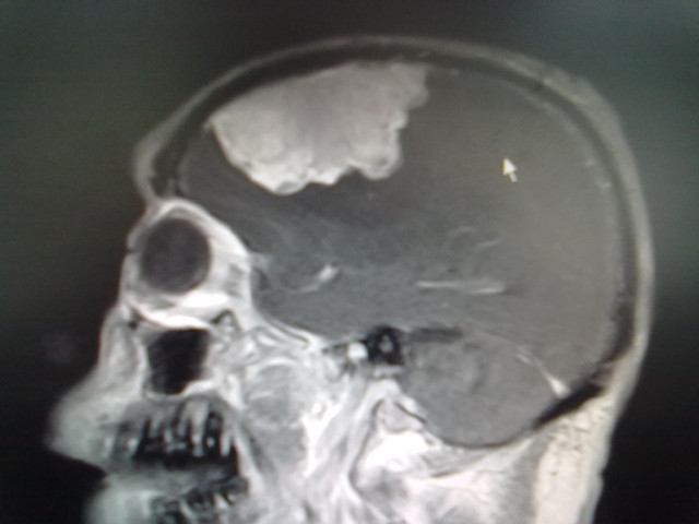 外六科成功为一患者切除矢状窦傍巨大脑膜瘤