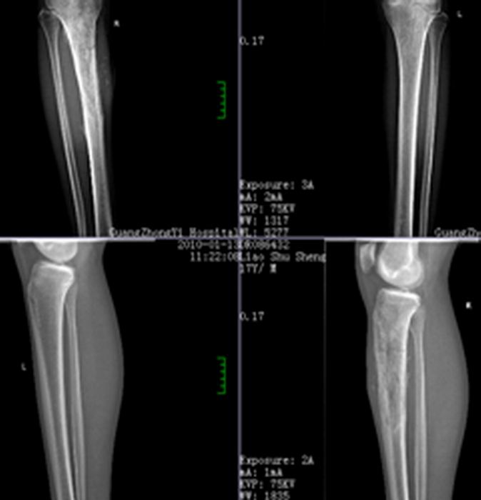 骨关节创伤手外科在膝关节外科手术方面再次取得突破