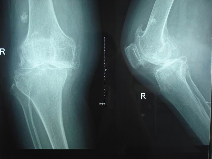 我院骨病科首例膝关节表面置换术获得成功