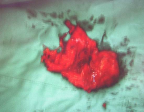 肝胆心胸外科成功施行巨大胸腺瘤并重症肌无力手术治疗