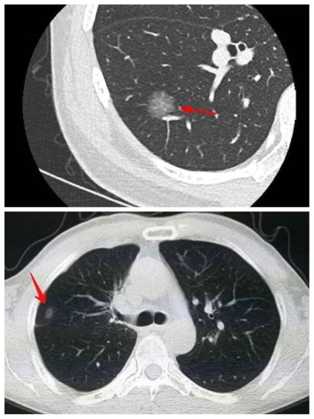 CT照出磨玻璃结节，就是得了肺癌吗？