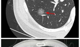 CT照出磨玻璃結節，就是得了肺癌嗎？