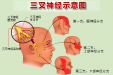 解除颜面部剧痛困扰，经皮穿刺微球囊压迫术微创治疗三叉神经痛！