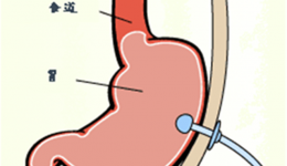 我院消化内镜诊疗部成功为102岁老人行胃镜下造瘘管置换术