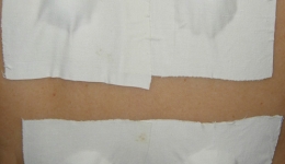 中药穴位敷贴治疗慢性荨麻疹