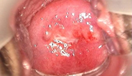 中药散治疗宫颈炎——广中医妇科中医特色