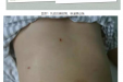 胆石病防治联盟