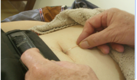 黄氏壮医针灸流派特色技术