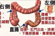 肠癌科普知识——结直肠癌防治知识