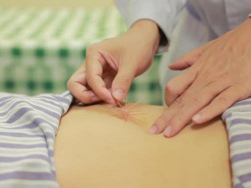 【特色壮医】五次治疗封印“社交尴尬”，壮医综合疗法让产后尿失禁按下“暂停键”！